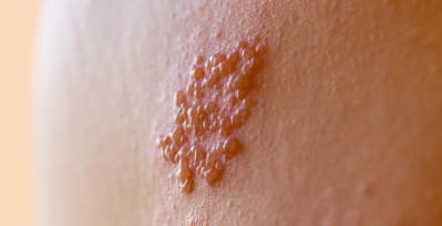 Shingles is a painful rash on the skin that comes from the same virus that causes chickenpox.